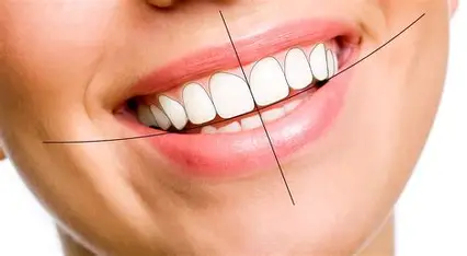 Smile Designing
